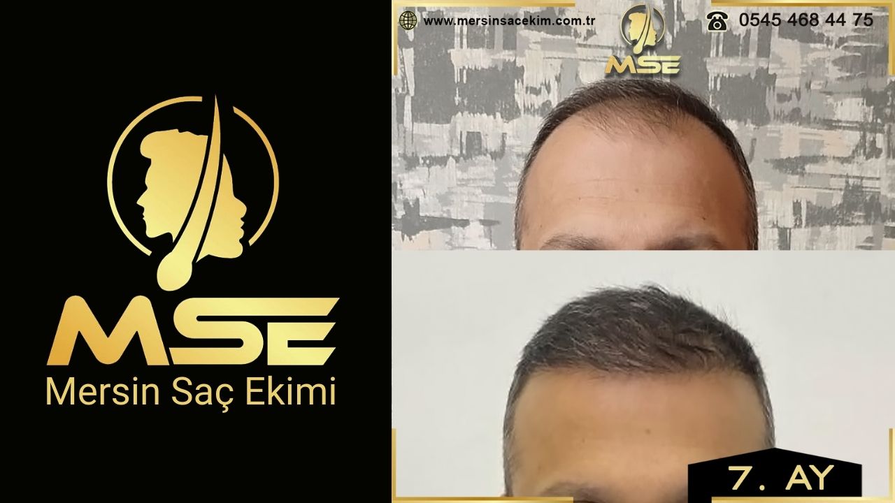 Mersin Saç Ekimi